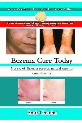 Eczema Cure Today - Get rid of Eczema forever natural ways to cure Eczema - Smit Chacha - cover