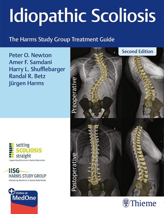 Idiopathic Scoliosis