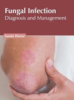 Fungal Infection: Diagnosis and Management