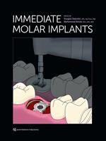 Immediate Molar Implants