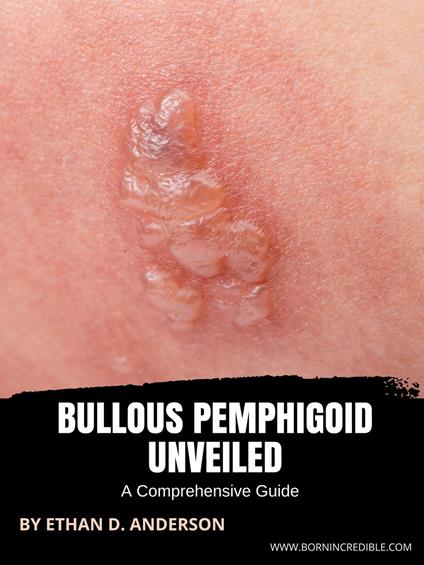 Bullous Pemphigoid Unveiled