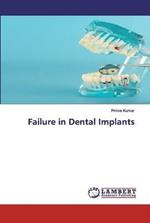 Failure in Dental Implants