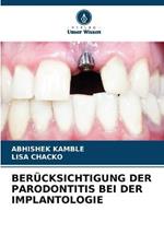 Berucksichtigung Der Parodontitis Bei Der Implantologie