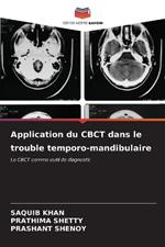 Application du CBCT dans le trouble temporo-mandibulaire