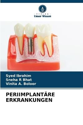 Periimplant?re Erkrankungen - Syed Ibrahim,Sneha R Bhat,Vinita A Boloor - cover