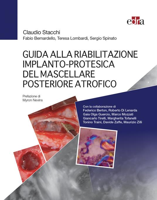 Guida alla riabilitazione implantoprotesica del mascellare posteriore atrofico - Claudio Stacchi,Fabio Bernardello,Teresa Lombardi - copertina