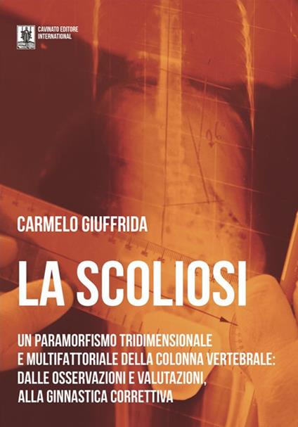 La scoliosi. Un paramorfismo tridimensionale e multifattoriale della colonna vertebrale: dalle osservazioni e valutazioni alla ginnastica correttiva - Carmelo Giuffrida - ebook