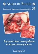 La rigenerazione ossea guidata nella pratica implantare