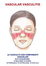 Vascular vasculitis. Vasculiti con componenti vascolari