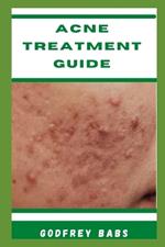 Acne Treatment Guide: Manage acne with ease